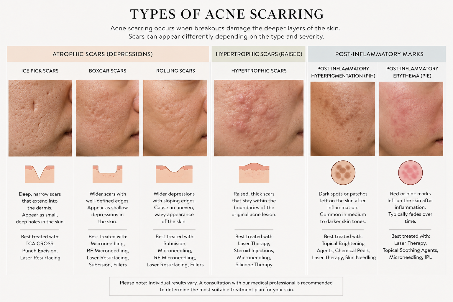types-of-scarring-from-acne