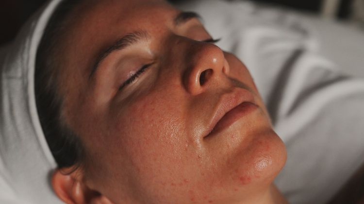 BBL HEROic treatment example at W Medical Aesthetics Adelaide