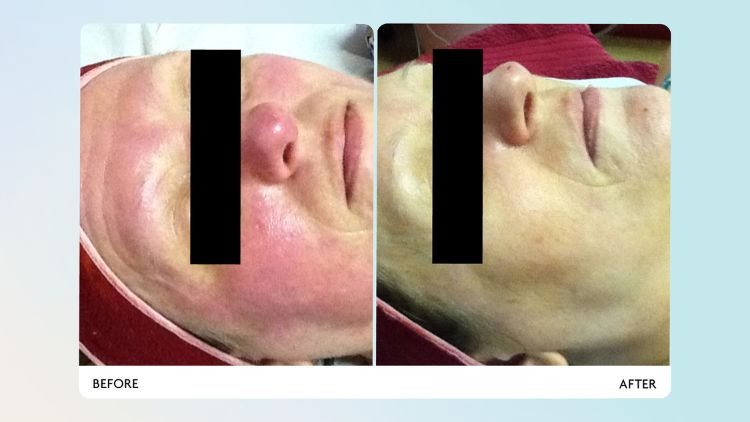 how-often-should-you-have-led-light-therapy