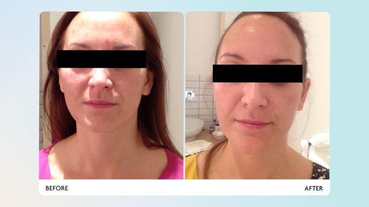 how-often-should-you-have-led-light-therapy