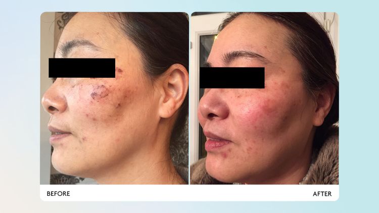 how-often-should-you-have-led-light-therapy