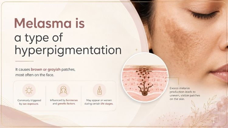 melasma-vs-hyperpigmentation
