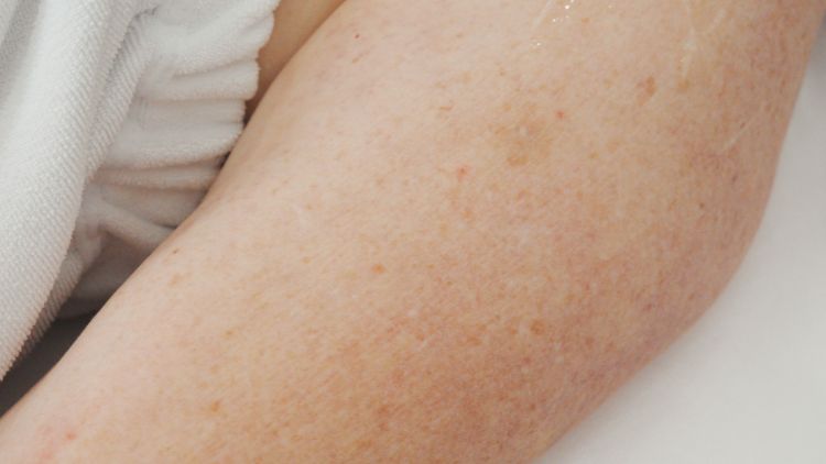 Close-up of skin and pigmented spots on an arm