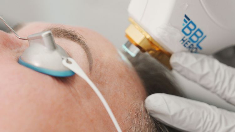 BBL HEROic handpiece with protective eye shields