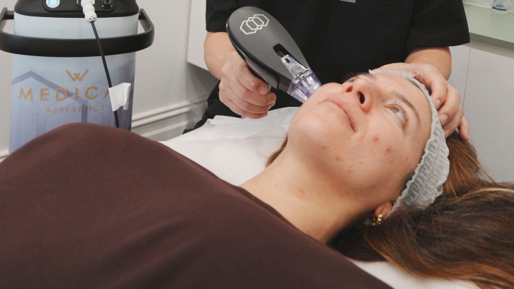 RF microneedling performed in a clinical setting