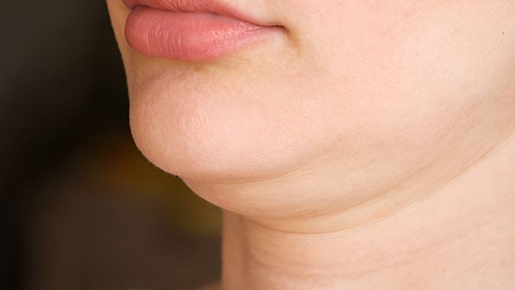 Example of the under-chin area being discussed, not a treatment outcome